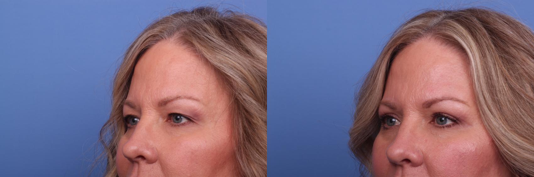 Before & After Blepharoplasty Case 452 Left Oblique View in Scottsdale, AZ