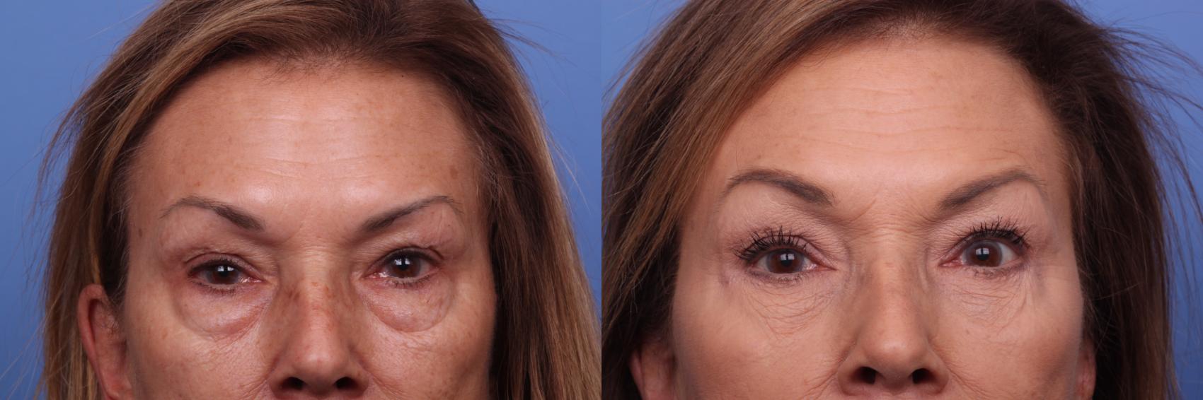 Before & After Blepharoplasty Case 459 Zoom Bleph View in Scottsdale, AZ