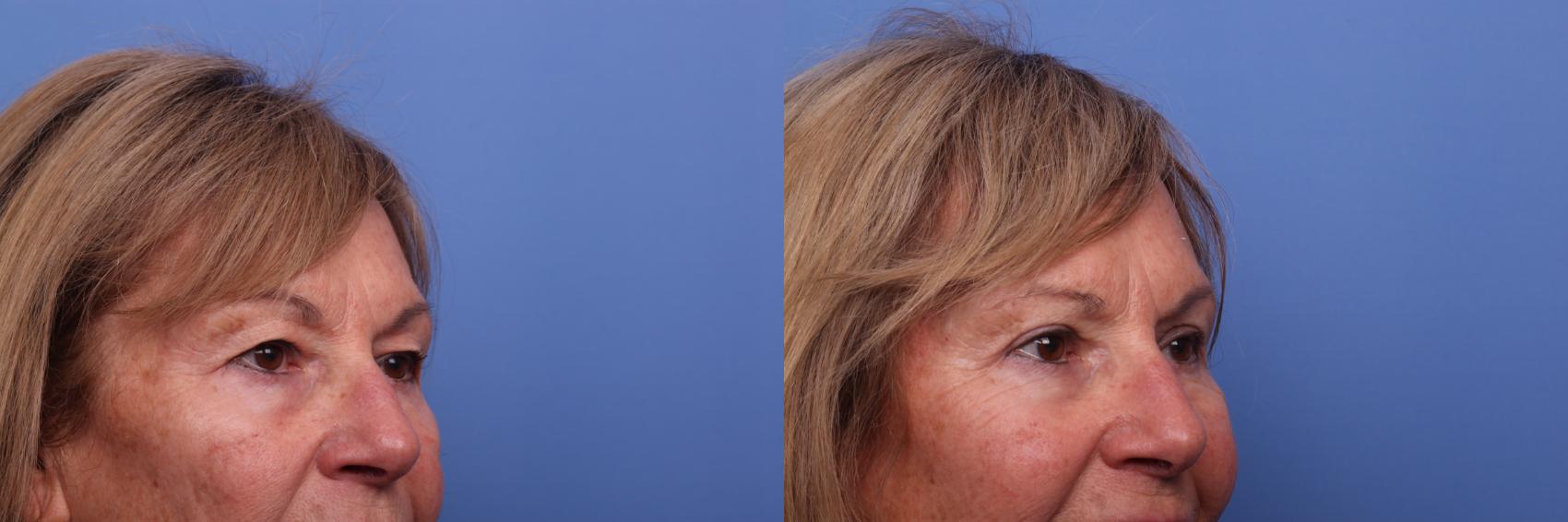 Before & After Blepharoplasty Case 473 Right Oblique View in Scottsdale, AZ