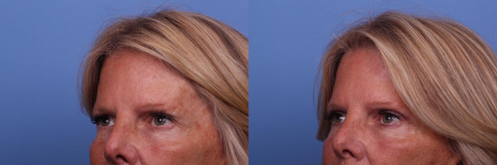 Before & After Brow Lift Case 475 Left Oblique View in Scottsdale, AZ