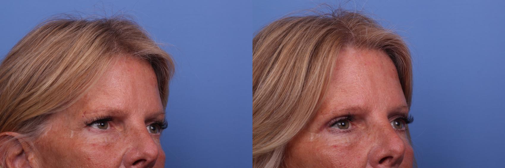 Before & After Brow Lift Case 475 Right Oblique View in Scottsdale, AZ