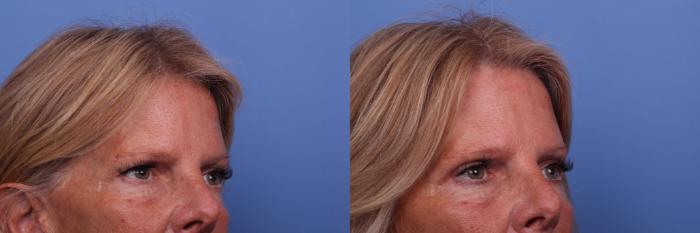 Brow Lift Before & After Photo | Scottsdale & Phoenix, AZ | Hobgood Facial Plastic Surgery: Todd Hobgood, MD