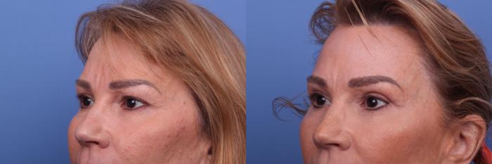 Blepharoplasty Before & After Photo | Scottsdale & Phoenix, AZ | Hobgood Facial Plastic Surgery: Todd Hobgood, MD