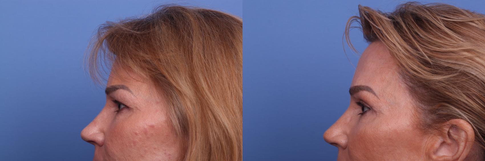 Before & After Blepharoplasty Case 477 Left Side View in Scottsdale, AZ
