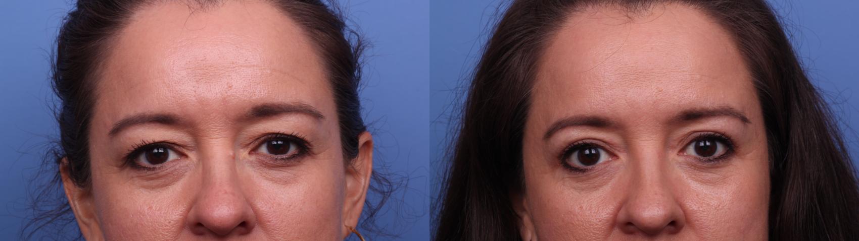 Blepharoplasty Before and After Pictures Case 485 | Scottsdale, AZ