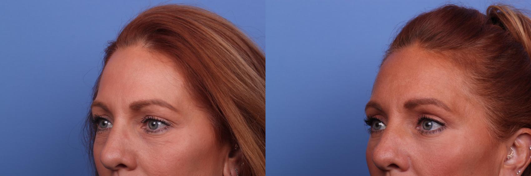 Before & After Blepharoplasty Case 493 Left Oblique View in Scottsdale, AZ