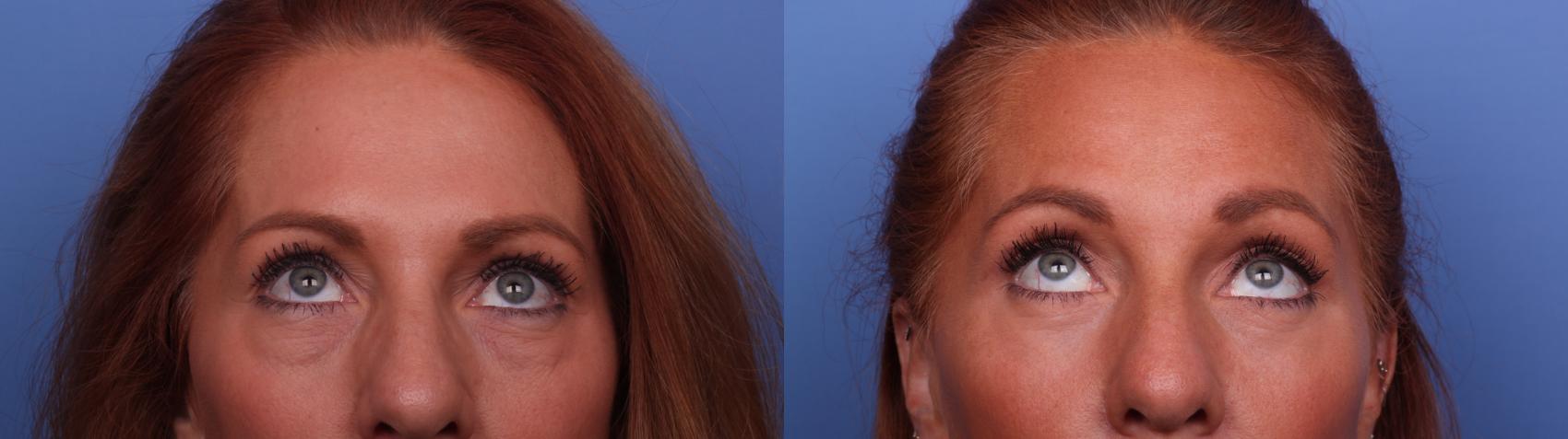 Before & After Blepharoplasty Case 493 Zoom Bleph 2 View in Scottsdale, AZ