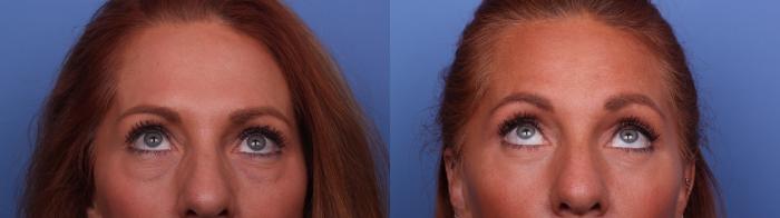 Blepharoplasty Before & After Photo | Scottsdale, AZ | Hobgood Facial Plastic Surgery: Todd Hobgood, MD