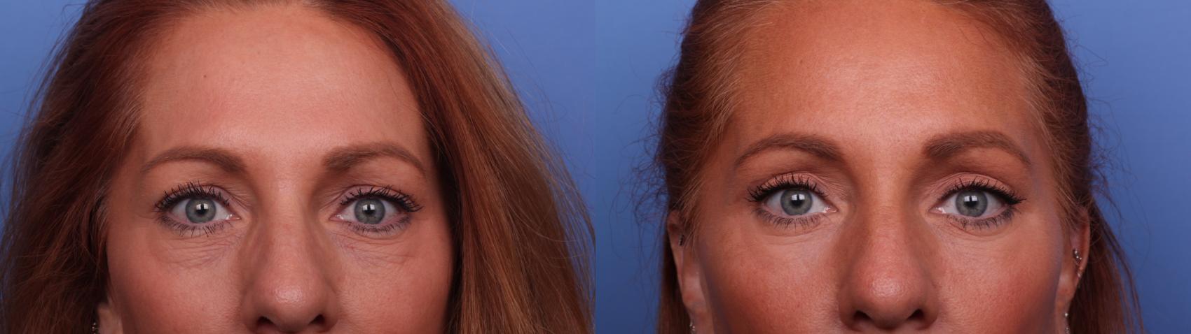 Before & After Blepharoplasty Case 493 Zoom Bleph View in Scottsdale, AZ