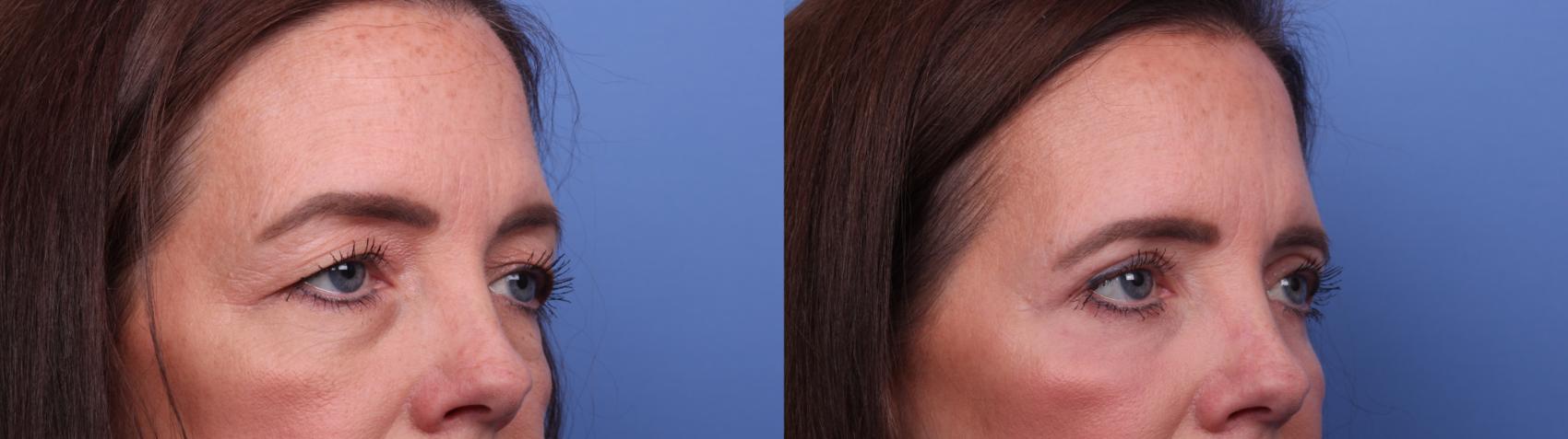 Before & After Blepharoplasty Case 503 Right Oblique View in Scottsdale, AZ