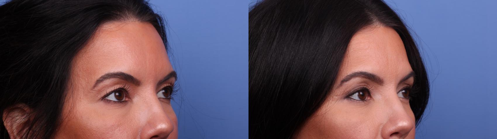 Before & After Blepharoplasty Case 505 Right Oblique View in Scottsdale, AZ