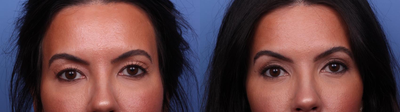 Before & After Blepharoplasty Case 505 Zoom Bleph View in Scottsdale, AZ