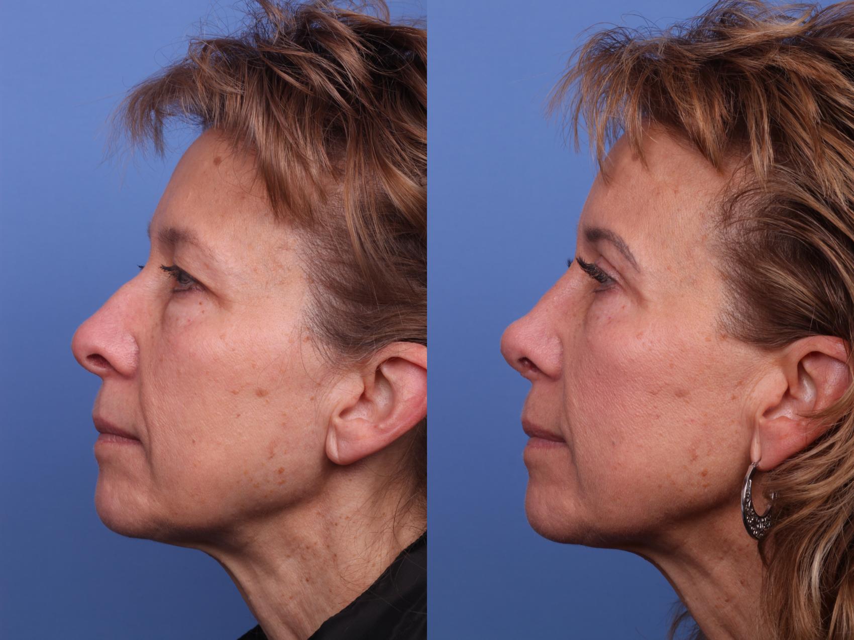Before & After Blepharoplasty Case 511 Left Side View in Scottsdale, AZ