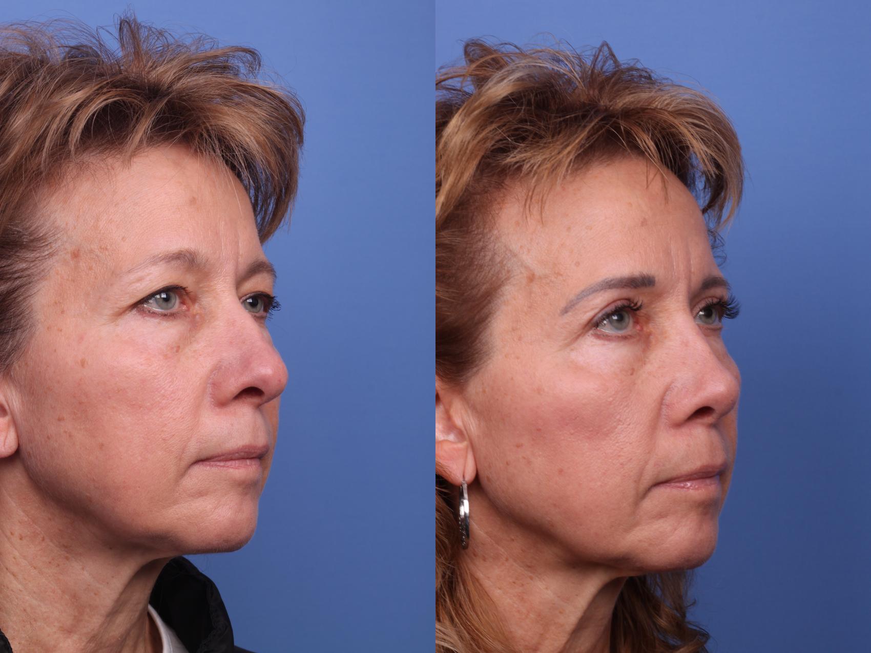 Before & After Blepharoplasty Case 511 Right Oblique View in Scottsdale, AZ