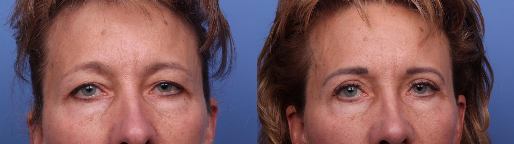 Before & After Blepharoplasty Case 511 Zoom Bleph View in Scottsdale, AZ