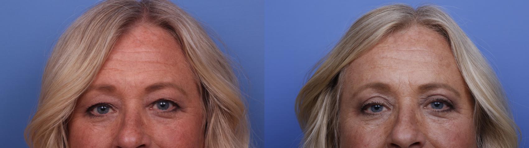 Blepharoplasty Before & After Photo | Scottsdale & Phoenix, AZ | Hobgood Facial Plastic Surgery: Todd Hobgood, MD