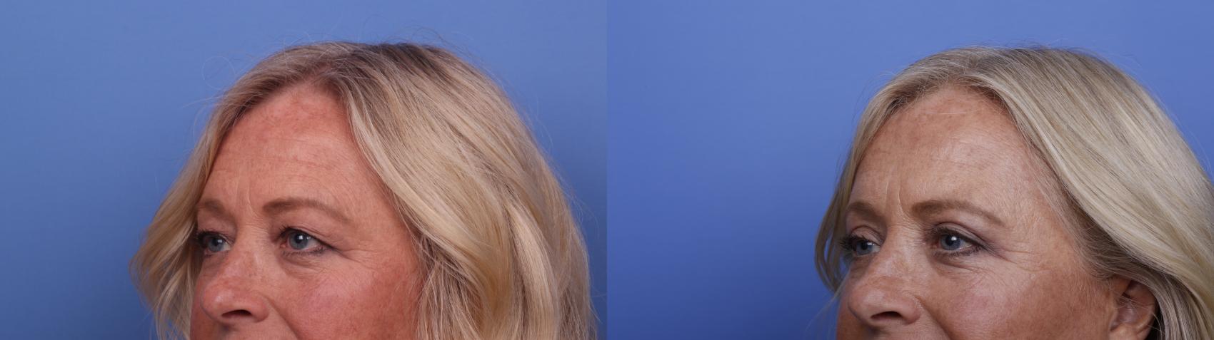 Before & After Blepharoplasty Case 521 Left Oblique View in Scottsdale, AZ