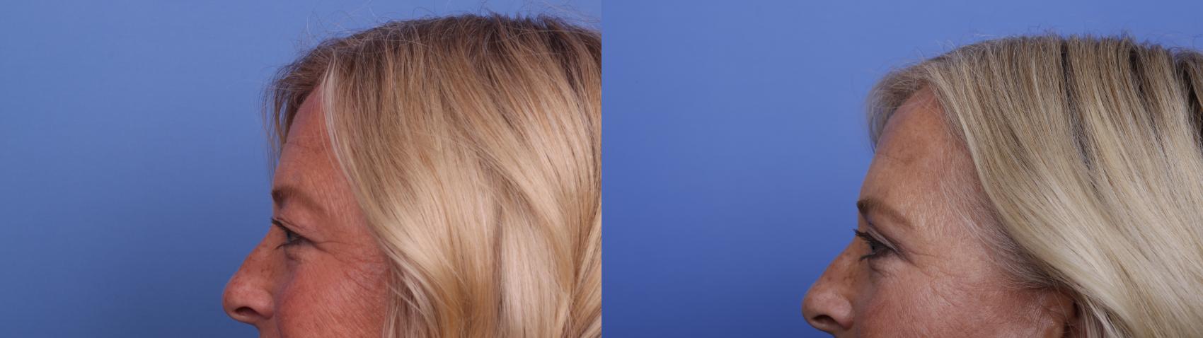 Before & After Blepharoplasty Case 521 Left Side View in Scottsdale, AZ