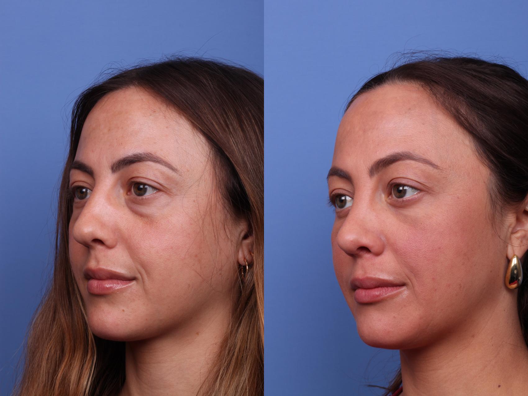 Before & After Rhinoplasty Case 526 Left Oblique View in Scottsdale, AZ