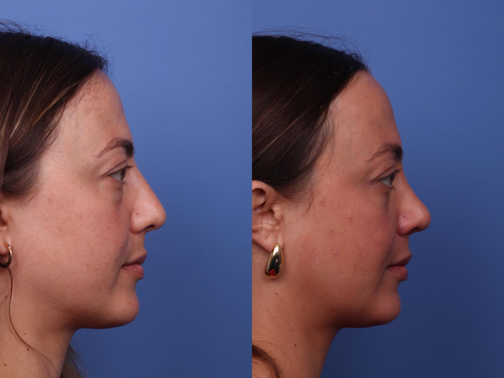 Before & After Rhinoplasty Case 526 Right Side View in Scottsdale, AZ