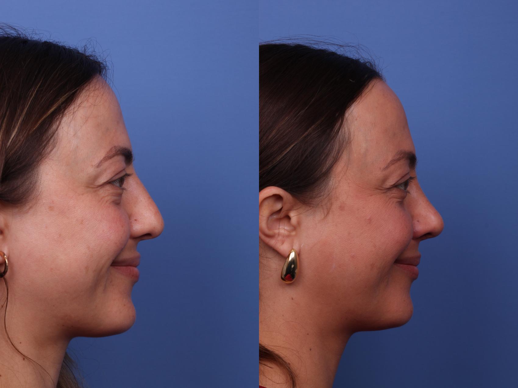 Before & After Rhinoplasty Case 526 Right Smile View in Scottsdale, AZ