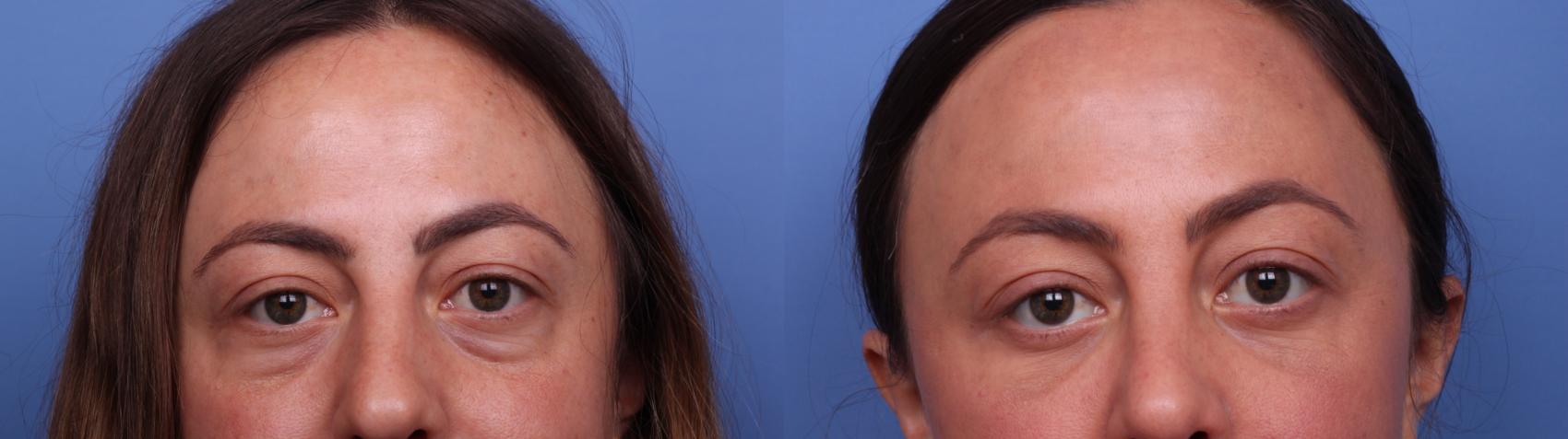 Before & After Rhinoplasty Case 526 Zoom Bleph View in Scottsdale, AZ