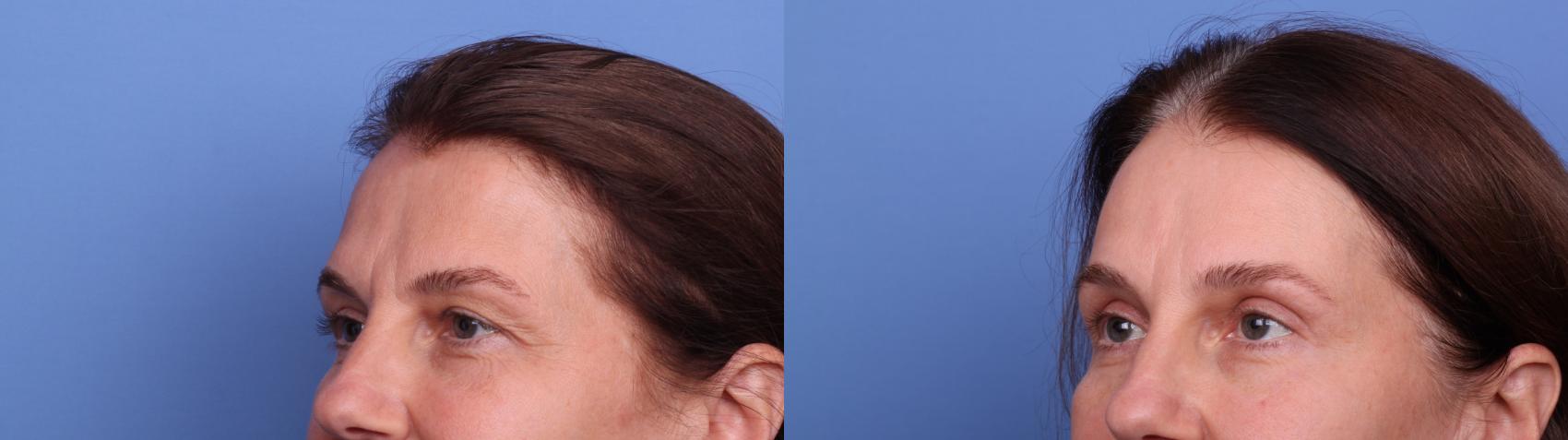 Before & After Blepharoplasty Case 532 Left Oblique View in Scottsdale, AZ
