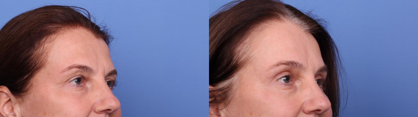 Before & After Blepharoplasty Case 532 Right Oblique View in Scottsdale, AZ