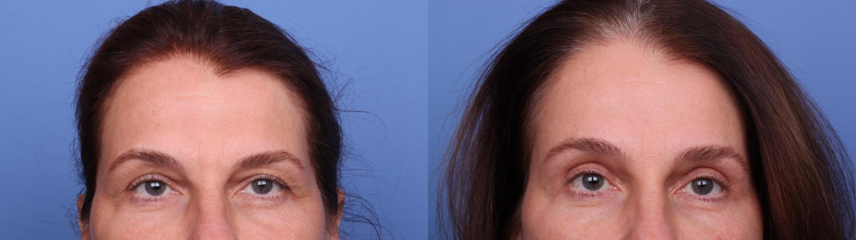 Before & After Blepharoplasty Case 532 Zoom Bleph View in Scottsdale, AZ