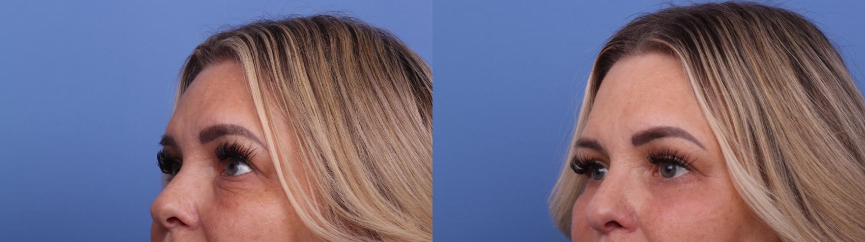 Before & After Blepharoplasty Case 542 Left Oblique View in Scottsdale, AZ