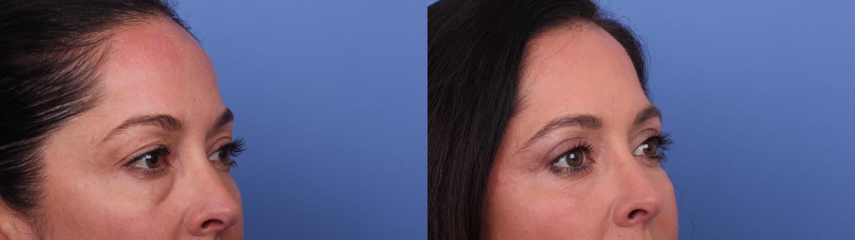 Before & After Blepharoplasty Case 546 Right Oblique View in Scottsdale, AZ
