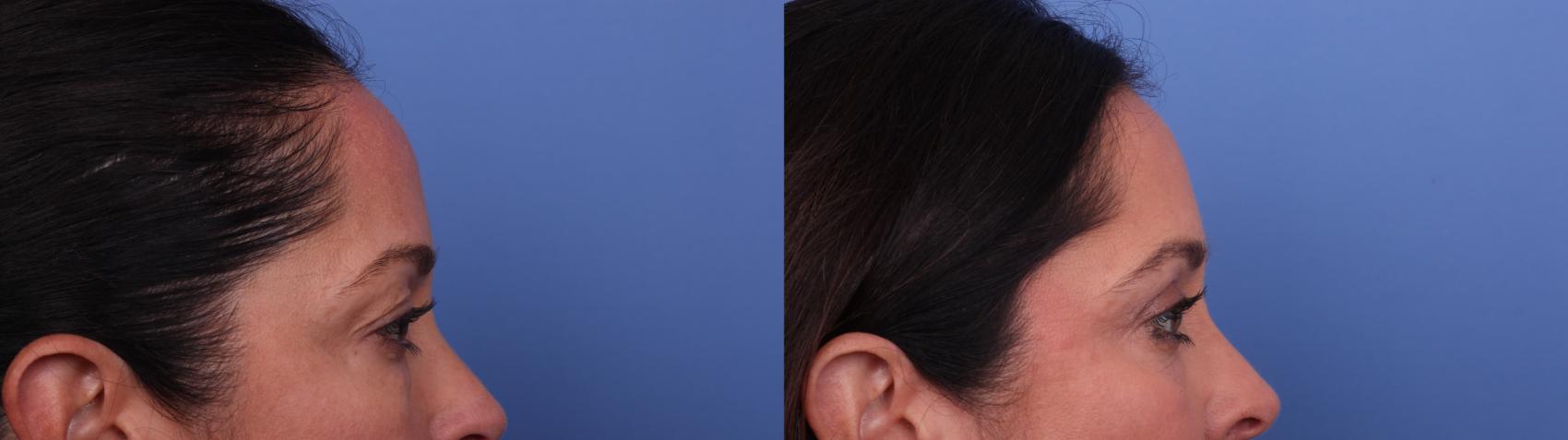 Before & After Blepharoplasty Case 546 Right Side View in Scottsdale, AZ