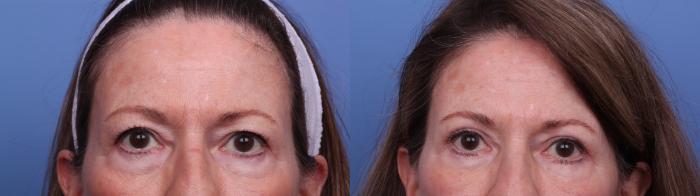 Before & After Blepharoplasty Case 547 Front View in Scottsdale, AZ