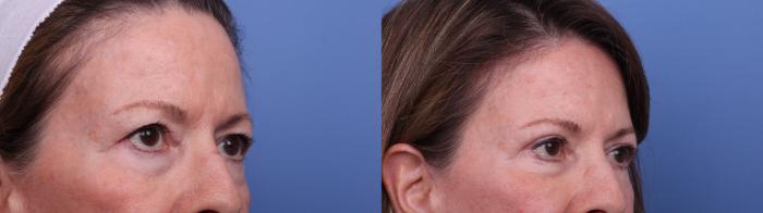 Before & After Blepharoplasty Case 547 Right Oblique View in Scottsdale, AZ