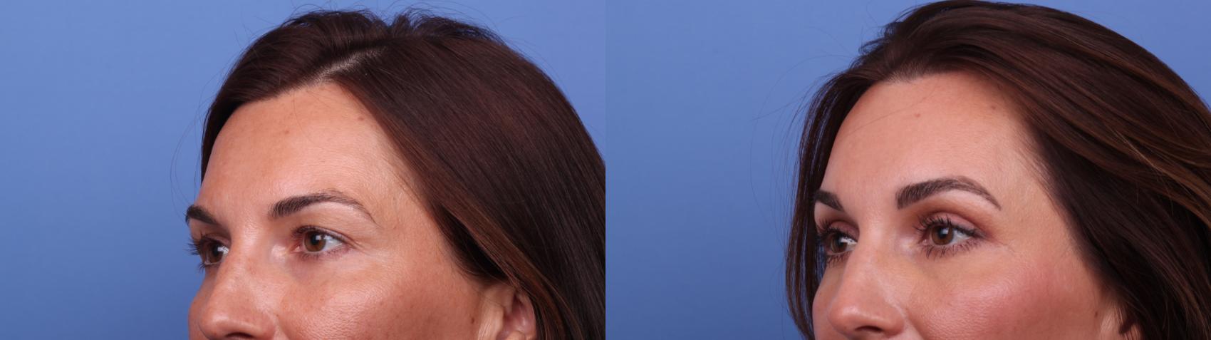 Before & After Brow Lift Case 558 Left Oblique View in Scottsdale, AZ