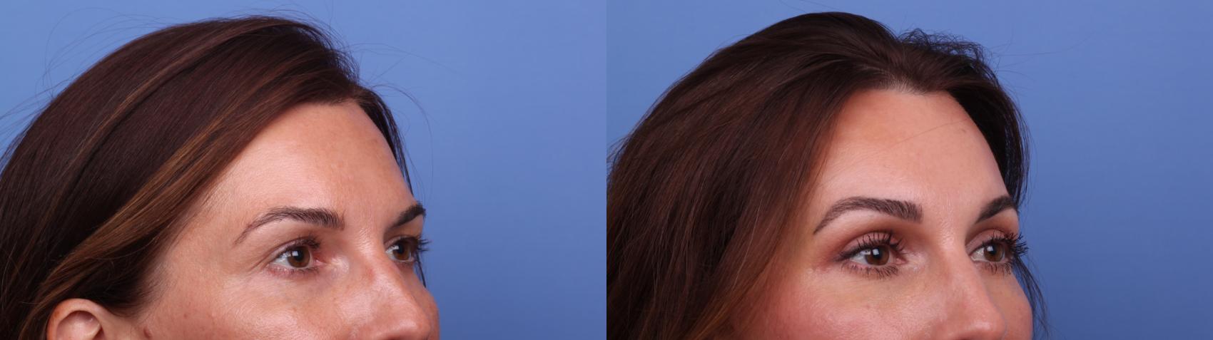 Before & After Brow Lift Case 558 Right Oblique View in Scottsdale, AZ