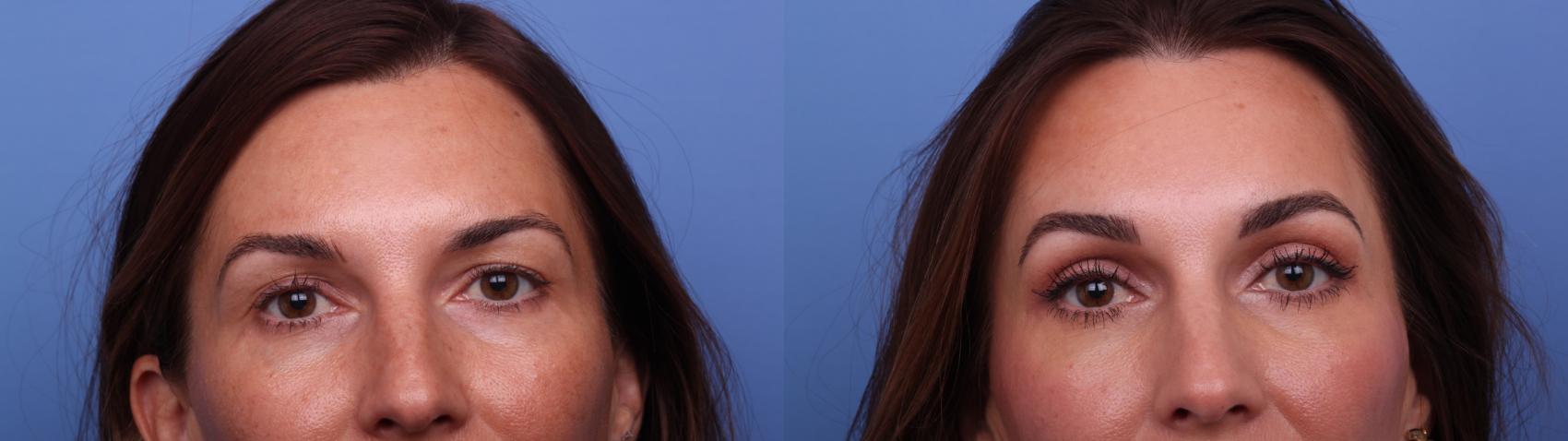 Before & After Brow Lift Case 558 Zoom Bleph View in Scottsdale, AZ
