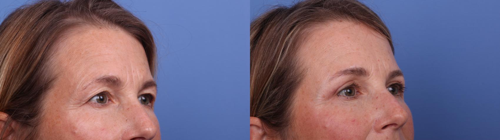Before & After Blepharoplasty Case 562 Right Oblique View in Scottsdale, AZ