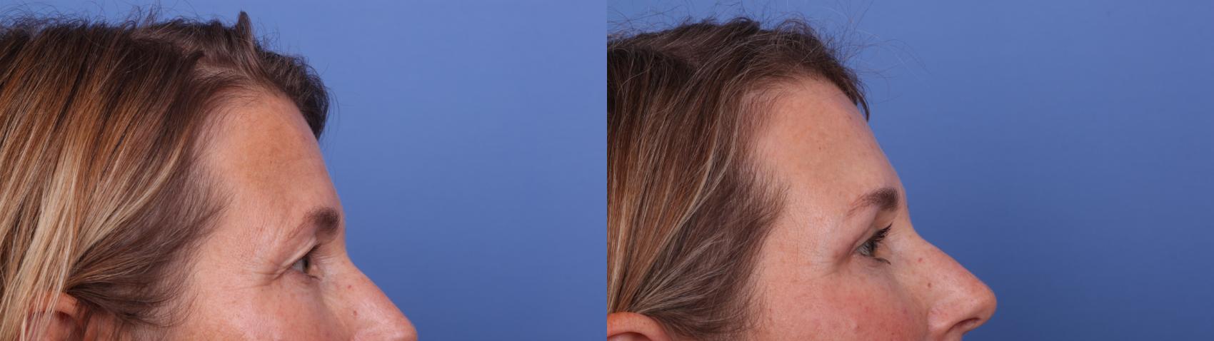 Before & After Blepharoplasty Case 562 Right Side View in Scottsdale, AZ
