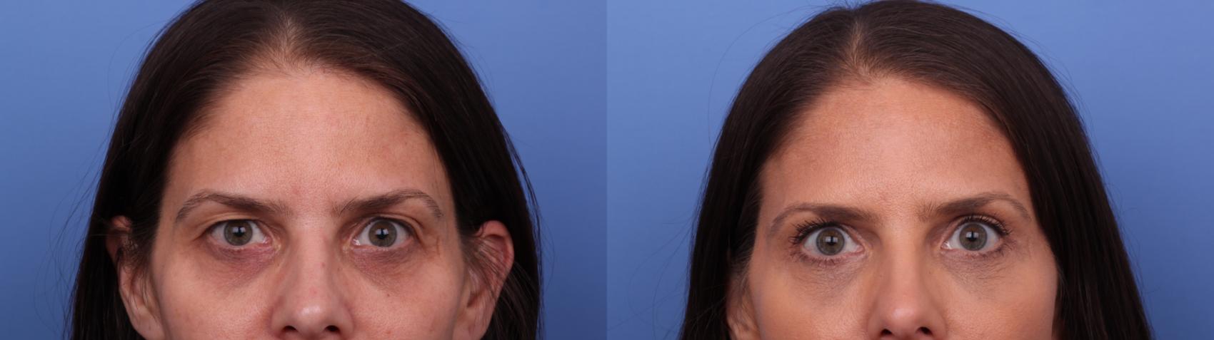 Blepharoplasty Before & After Photo | Scottsdale & Phoenix, AZ | Hobgood Facial Plastic Surgery: Todd Hobgood, MD