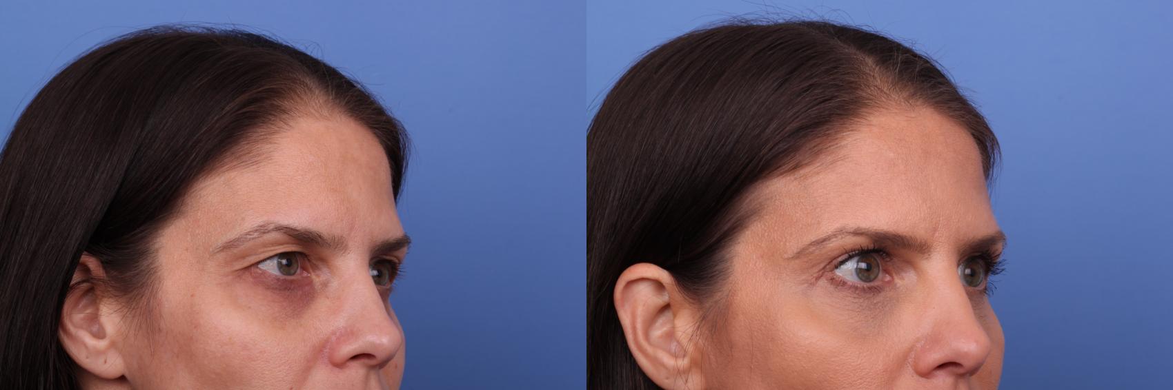 Before & After Blepharoplasty Case 566 Right Oblique View in Scottsdale, AZ