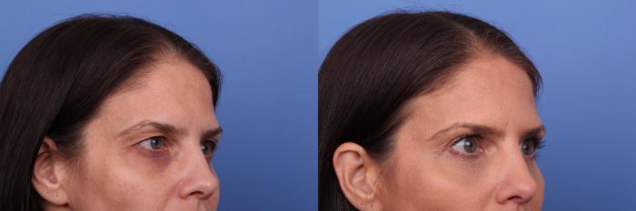 Blepharoplasty Before & After Photo | Scottsdale & Phoenix, AZ | Hobgood Facial Plastic Surgery: Todd Hobgood, MD