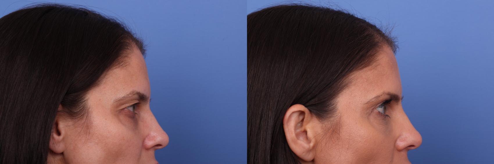 Before & After Blepharoplasty Case 566 Right Side View in Scottsdale, AZ