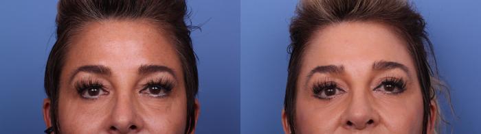 Blepharoplasty Before & After Photo | Scottsdale & Phoenix, AZ | Hobgood Facial Plastic Surgery: Todd Hobgood, MD