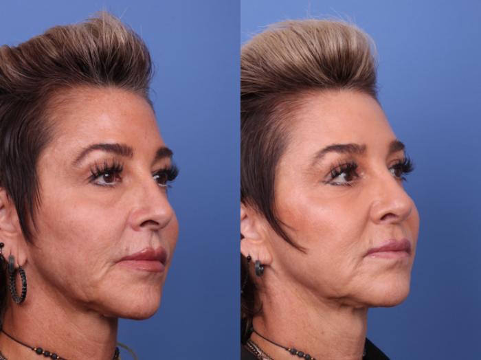 Blepharoplasty Before & After Photo | Scottsdale & Phoenix, AZ | Hobgood Facial Plastic Surgery: Todd Hobgood, MD