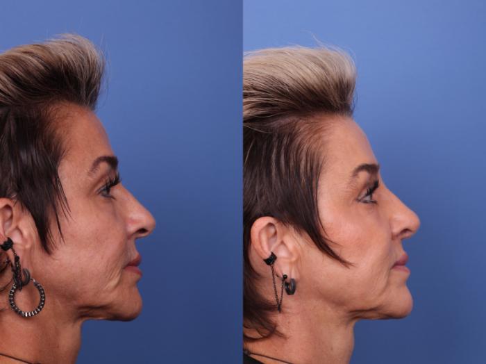 Blepharoplasty Before & After Photo | Scottsdale & Phoenix, AZ | Hobgood Facial Plastic Surgery: Todd Hobgood, MD