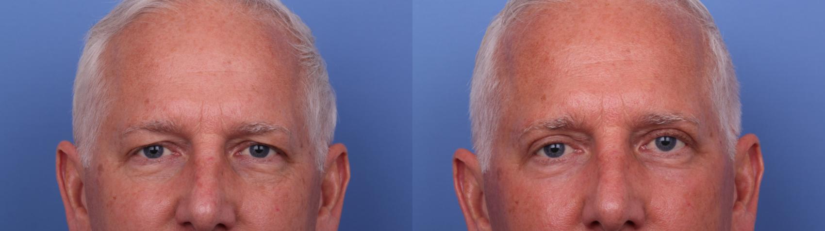 Blepharoplasty Before & After Photo | Scottsdale & Phoenix, AZ | Hobgood Facial Plastic Surgery: Todd Hobgood, MD