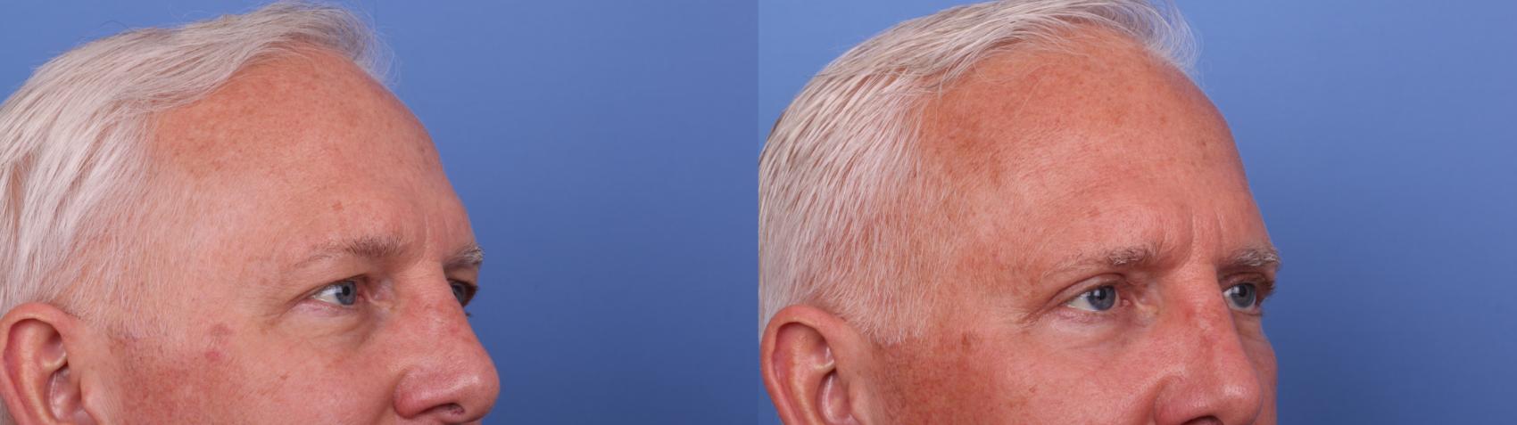 Before & After Blepharoplasty Case 575 Right Oblique View in Scottsdale, AZ
