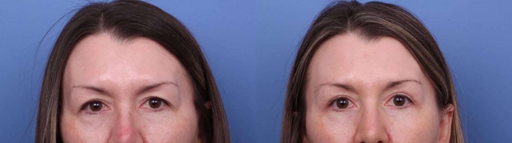 Blepharoplasty Before & After Photo | Scottsdale & Phoenix, AZ | Hobgood Facial Plastic Surgery: Todd Hobgood, MD