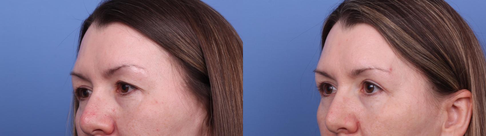 Before & After Blepharoplasty Case 592 Left Oblique View in Scottsdale, AZ